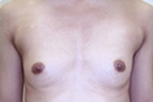 シンデレラ豊胸術の施術前　症例写真1