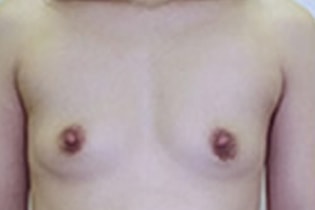 シンデレラ豊胸術の施術前　症例写真2