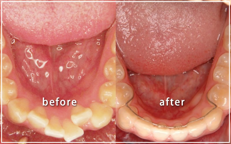 第一小臼歯を抜歯した治療の症例