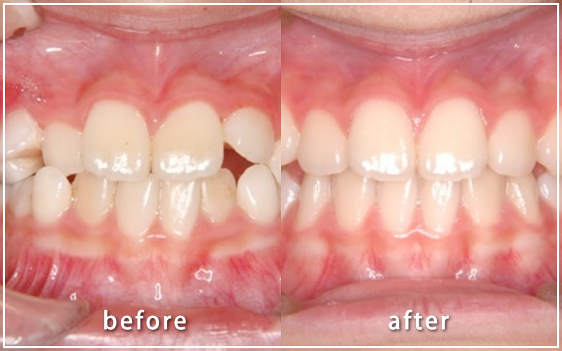 クワドヘリックスで拡大した上下の歯並びの症例
