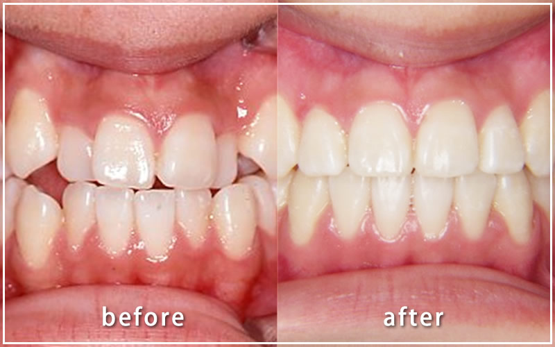 クワドヘリックスとバイヘリックスで治療した上下の歯並びの症例