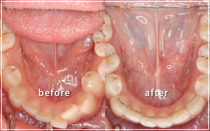 抜歯して治療した下の歯並びの症例