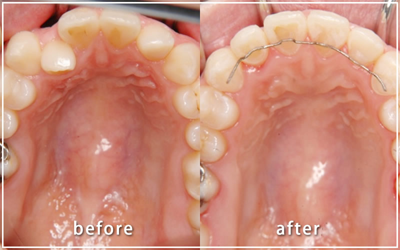 保定装置を装着している下の歯並びの症例