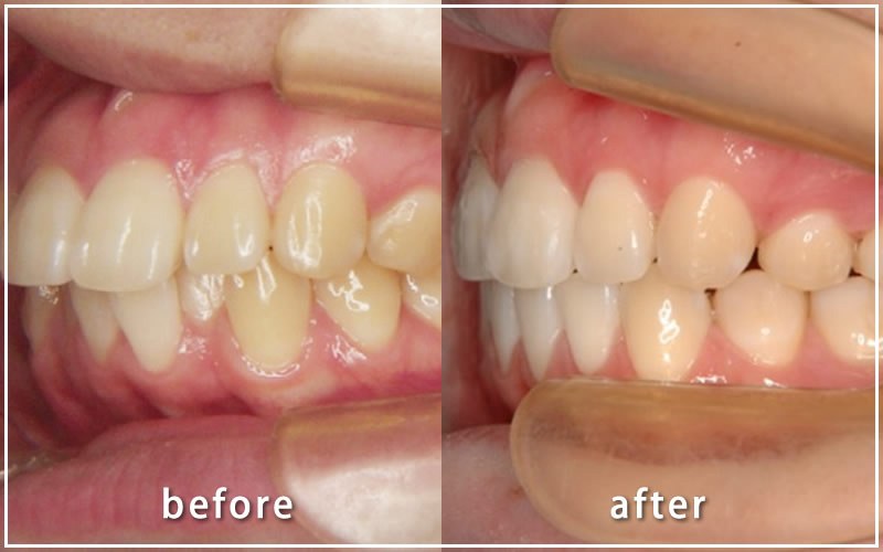 両側の第一小臼歯を抜歯する治療の上下の歯列の症例