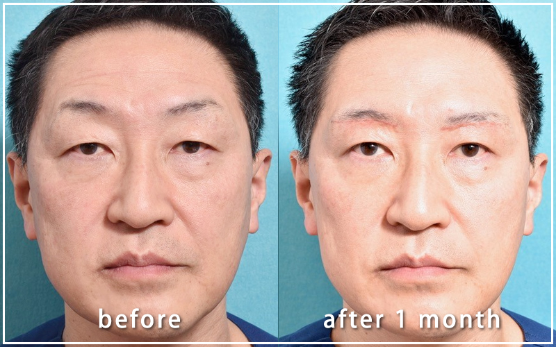 手術１ヶ月後の亀井院長の写真