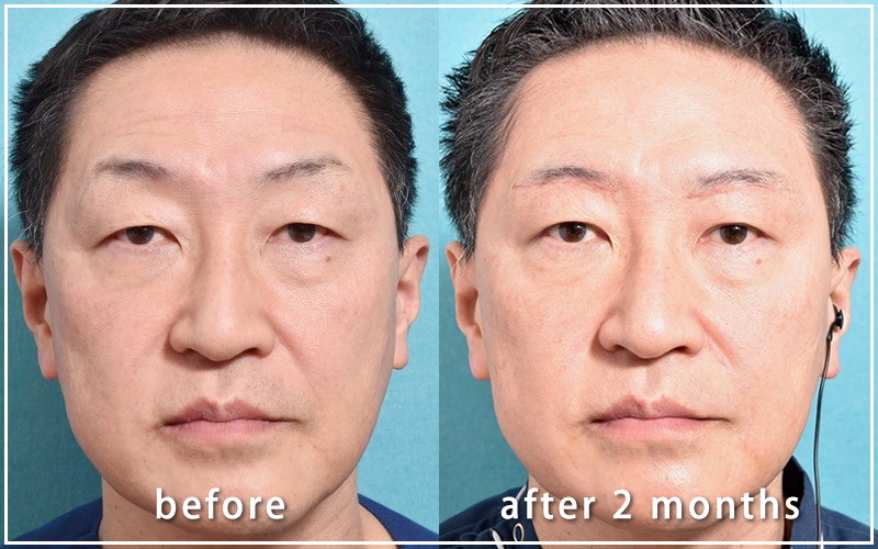 手術２ヶ月後の亀井院長の写真