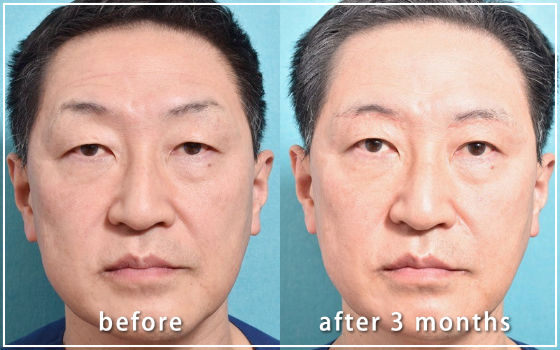 手術３ヶ月後の亀井院長の写真