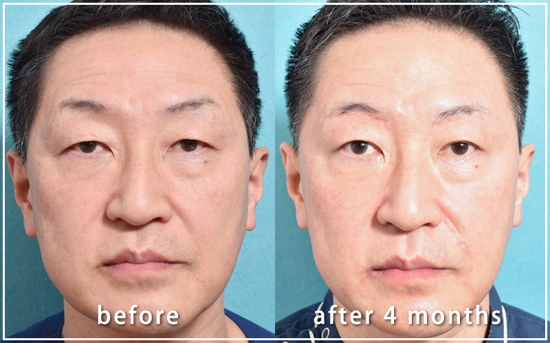 手術４ヶ月後の亀井院長の写真