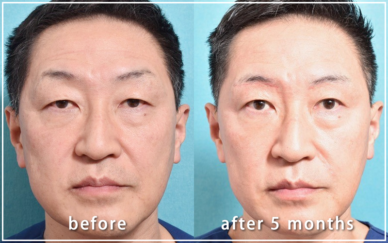 手術５ヶ月後の亀井院長の写真