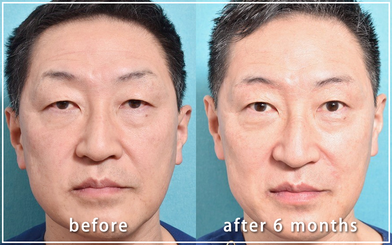 手術６ヶ月後の亀井院長の写真