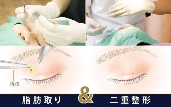瞼の脂肪取りの効果や料金について 共立式シェイプ法は共立美容外科