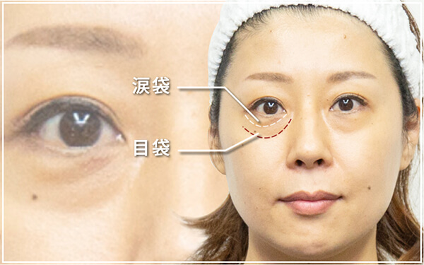 目の下のたるみ取り治療のダウンタイムや値段 手術方法 共立美容外科