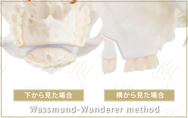 下側や横側から上顎の骨を見た場合のイメージ