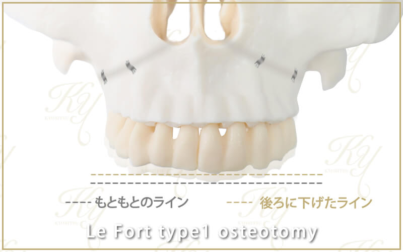ルフォー1型骨切り術の、もともとの上顎の位置と完成後の位置の比較