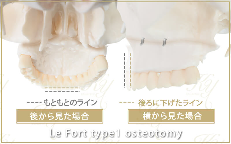 ルフォー1型骨切り術の仕上がりを後ろ側や横側から見たイメージ
