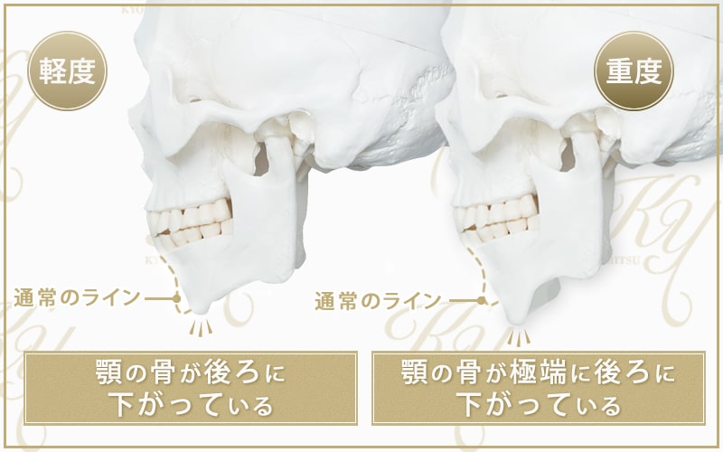 下顎の骨が原因の場合