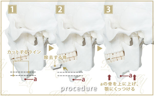 下顎の骨を前に出す施術の手順 1-3