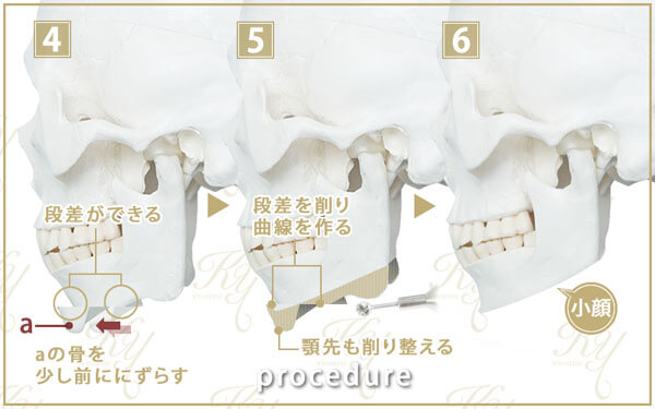 下顎の骨を前に出す施術の手順 4-6